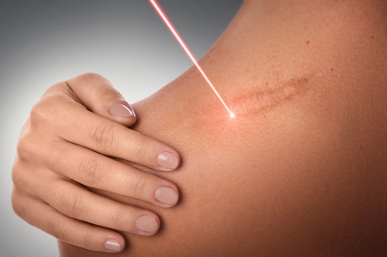 laser w terapii bólu Nowy Sącz